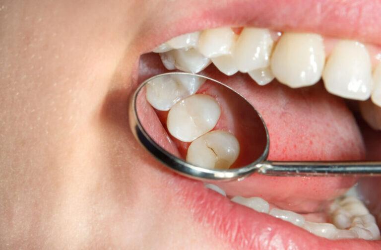 What Does a Cavity Look Like? Understanding Dental Cavities